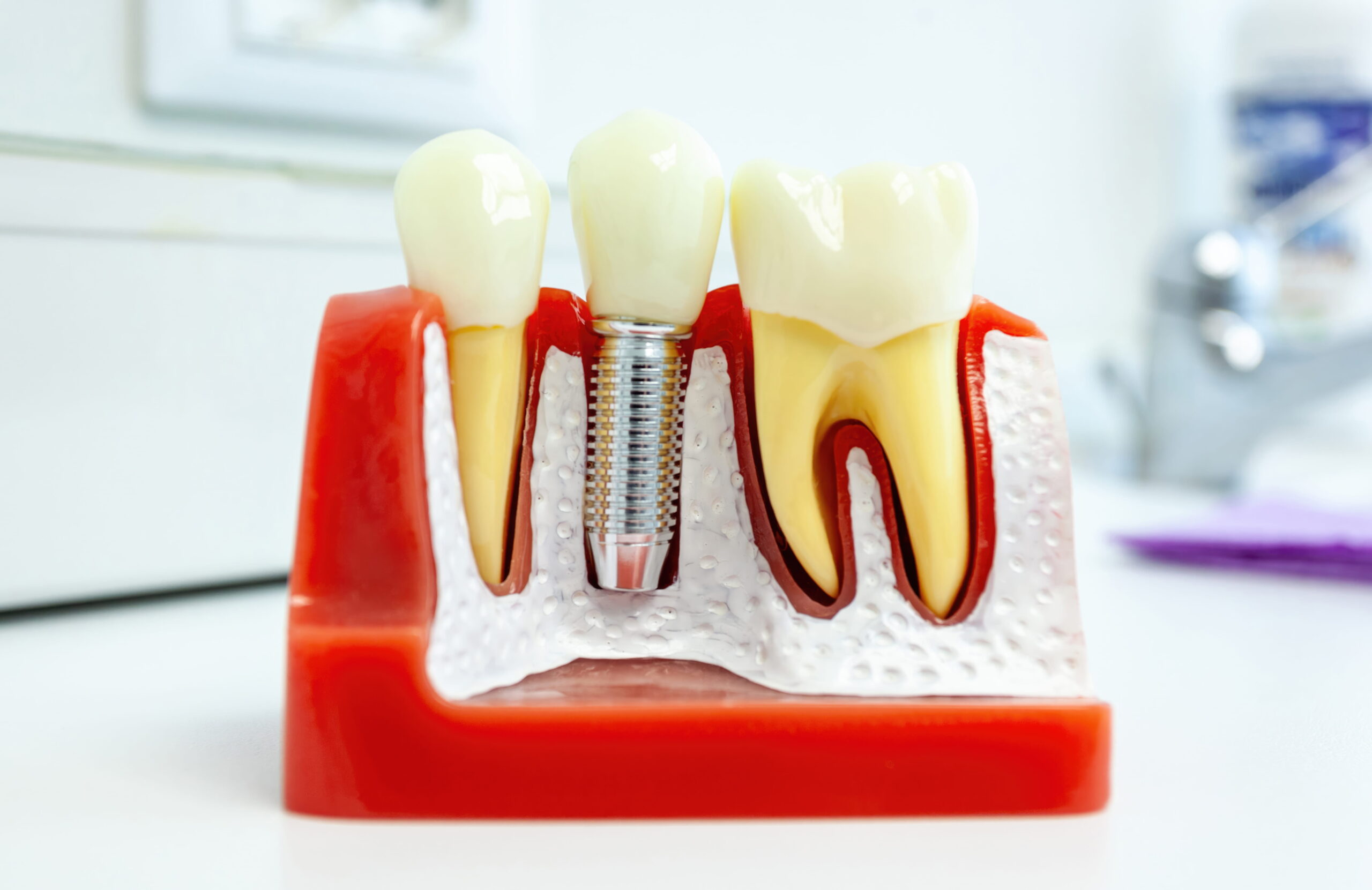 Budowa implantów zębowych