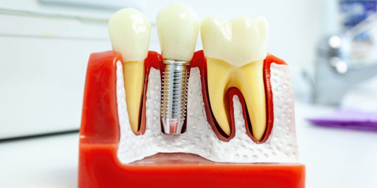 Budowa implantów zębowych